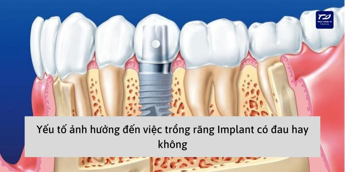 trồng răng implant nha trang