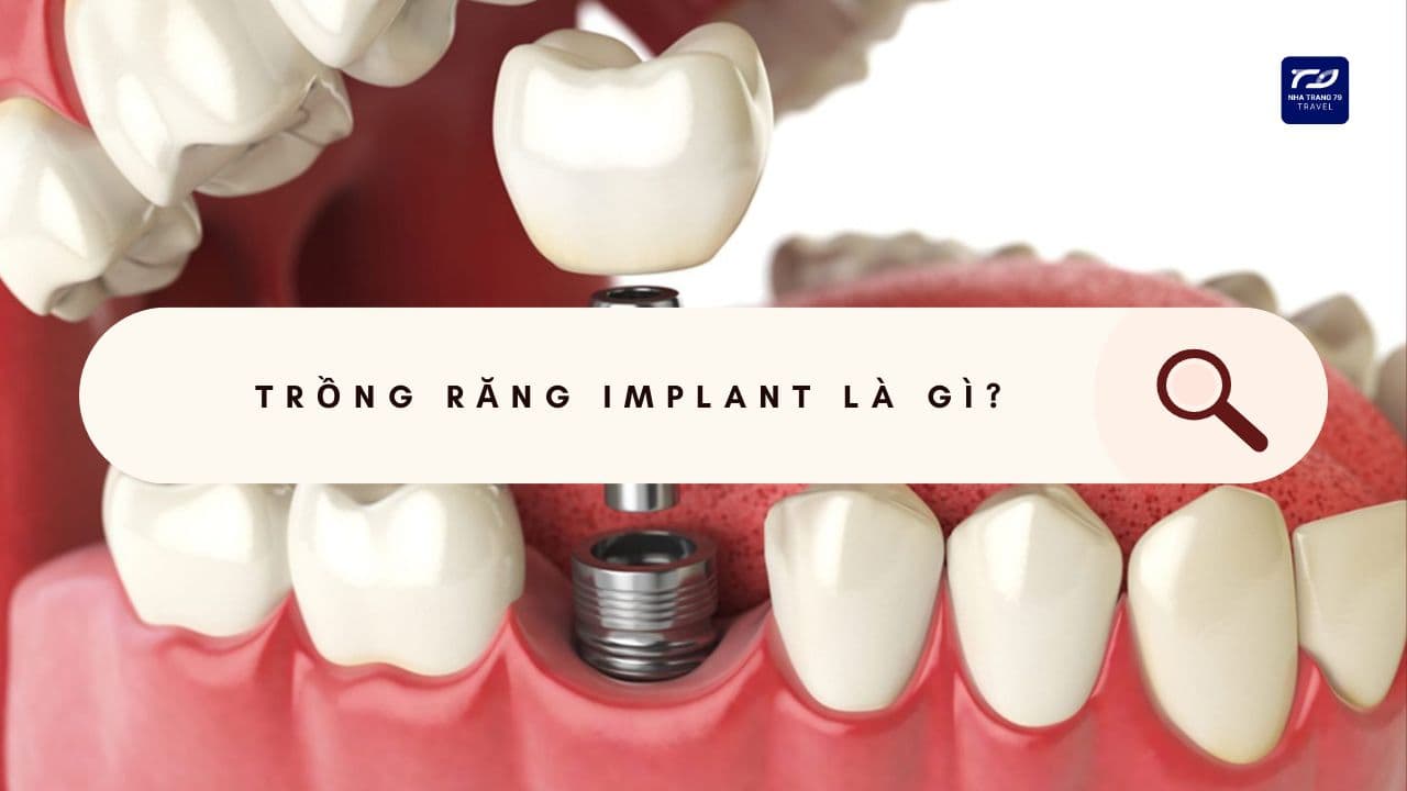 trồng răng implant nha trang