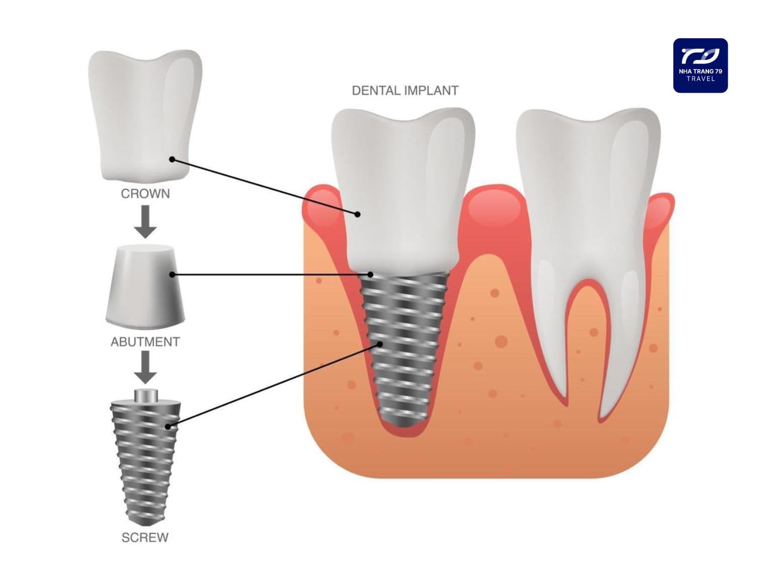 trồng răng implant nha trang