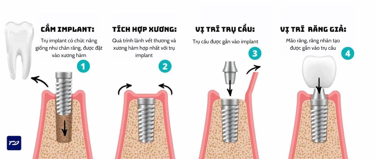 trồng răng implant nha trang