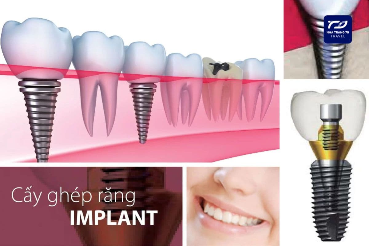 trồng răng implant nha trang
