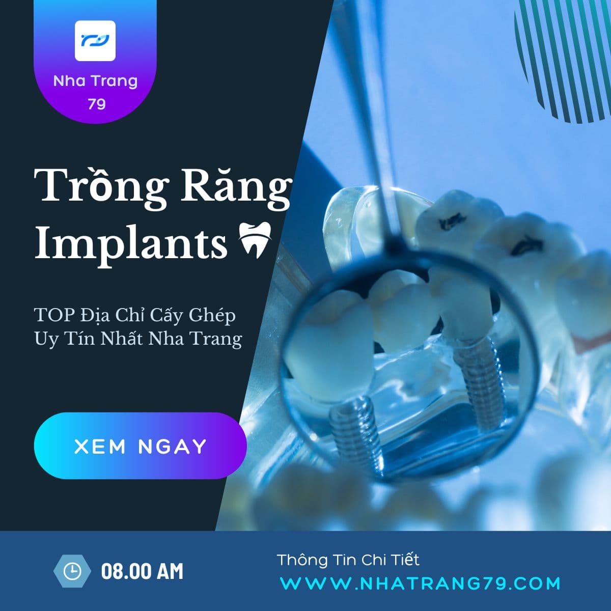 Địa Chỉ Trồng Răng Implant Nha Trang